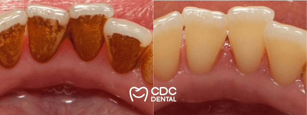 tooth stain air flow cleaning