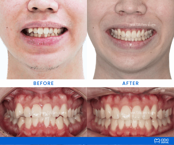Clear Aligners Review Crowding