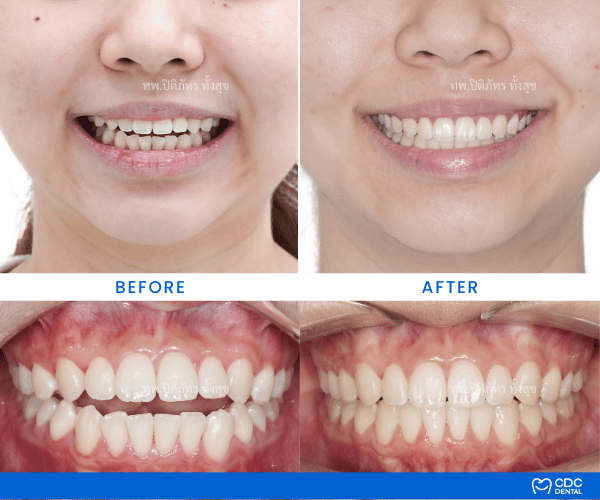 Clear Aligners Review Open Bite