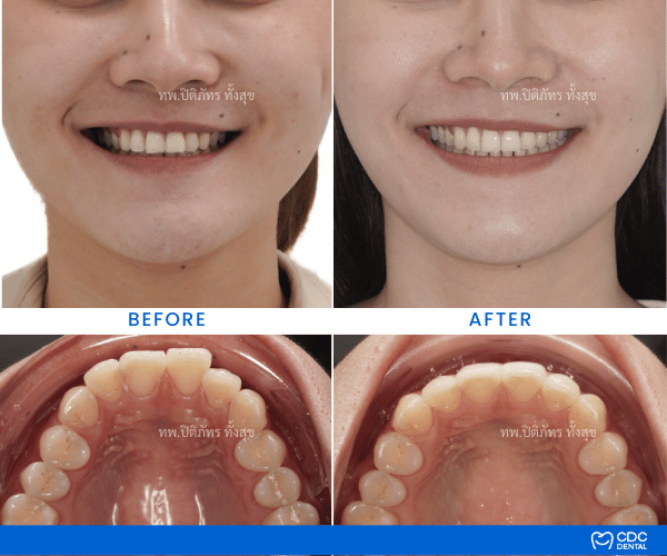 Review Protruding Teeth