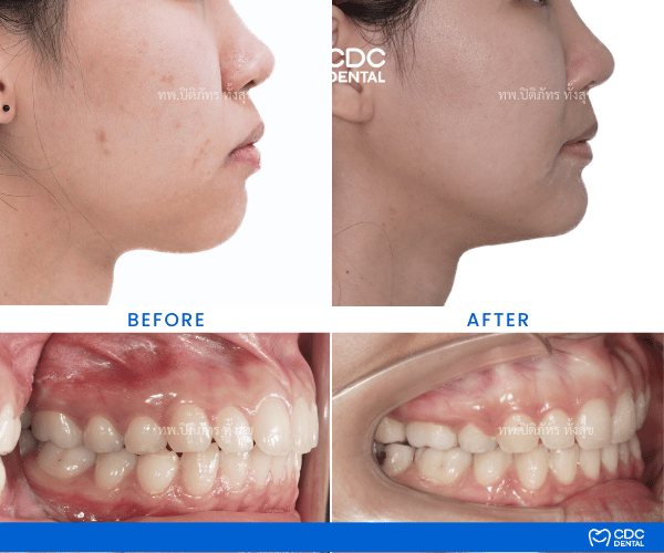 Clear Aligners Review Protrusion