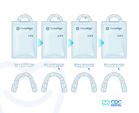 How clear aligners work