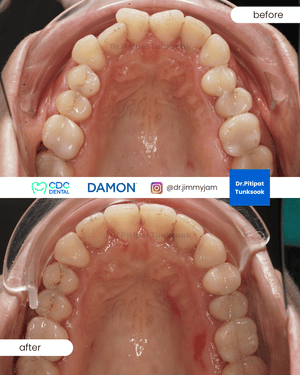 Damon arch expansion