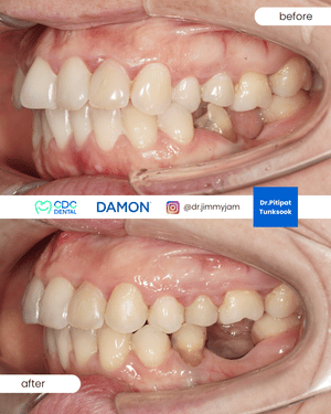 Damon occlusion correction