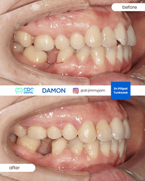 High canine damon braces