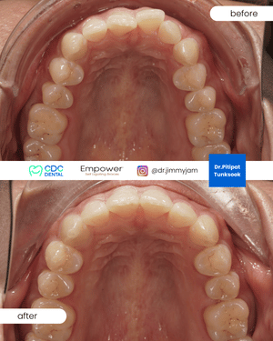 Non extraction braces