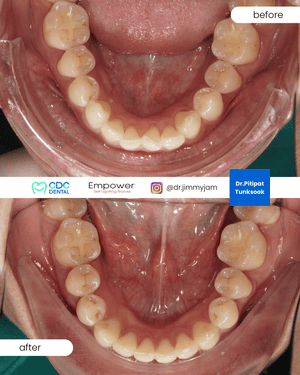 Damon braces crowding correction