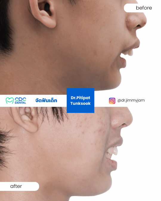 Buck teeth correction
