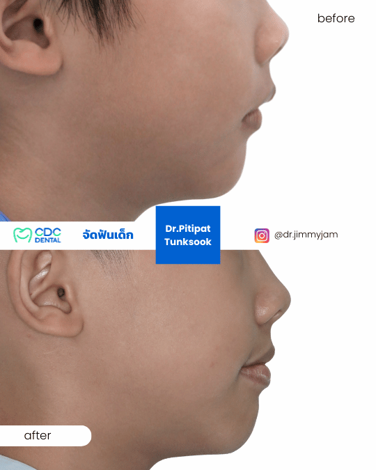 Palatal expansion results