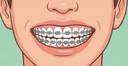 Phase 2 Braces