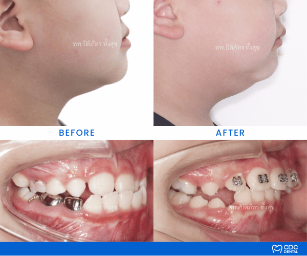 Facemask orthodontics case review