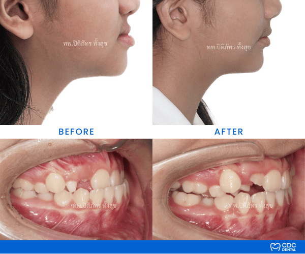 Results of correcting underbites in kids using a Facemask
