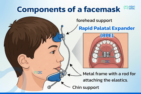 Components of the Facemask appliance