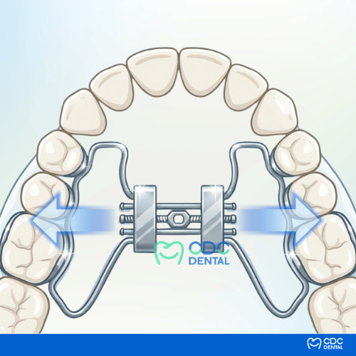 RPE rapid palatal expander appliance