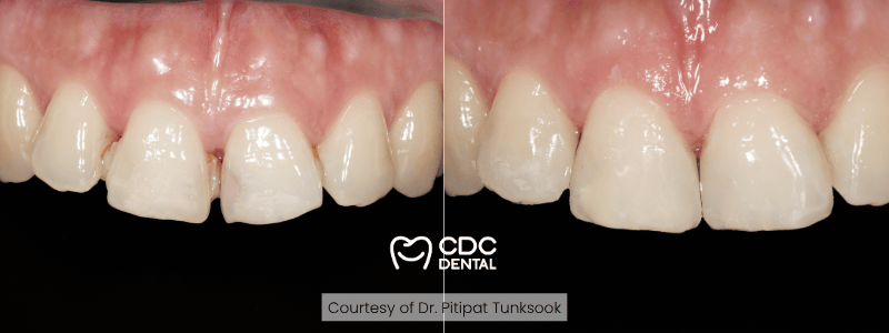 dental bonding bangkok