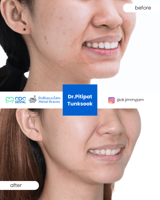 Braces retreatment tooth alignment mapping