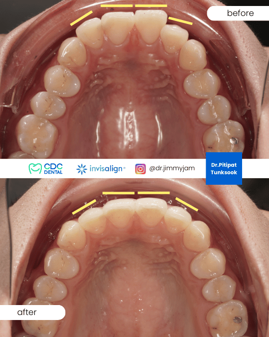 Second round braces teeth relapse correction