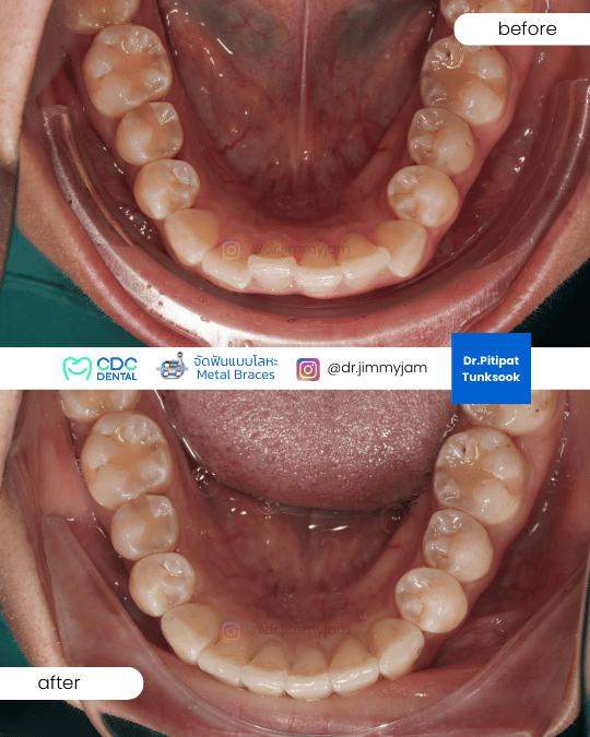Relapse caused by missing retainer wear