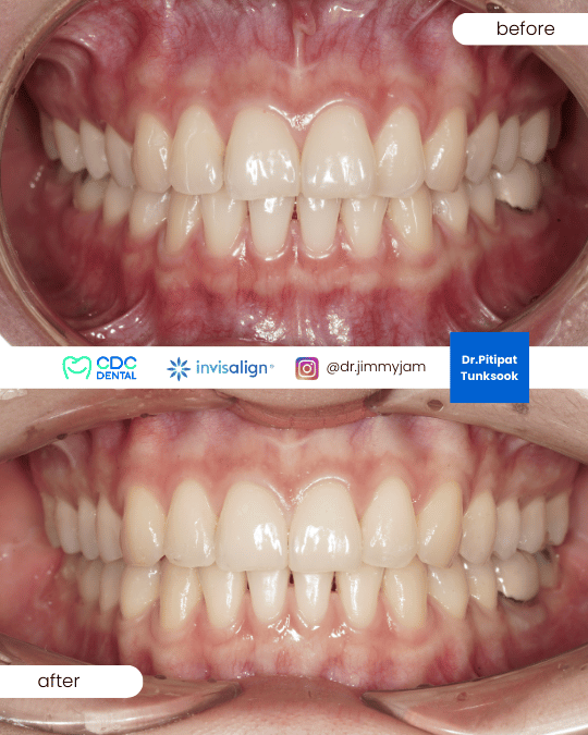 Smile renewal journey through orthodontics