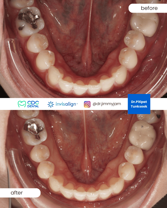 Midline correction through second round braces