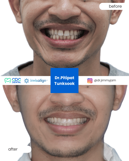 Closing gaps from dental relapse