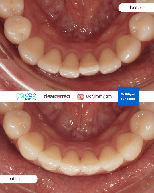 Crowded teeth second round alignment