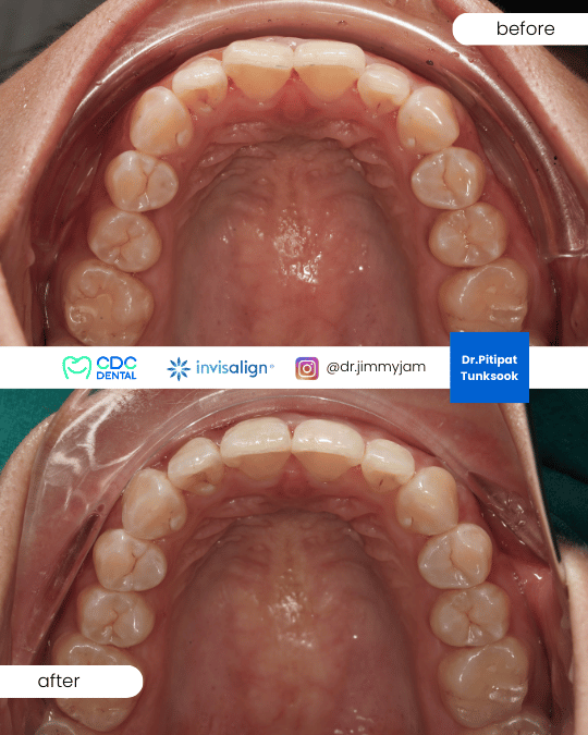 Final aligned bite retreatment