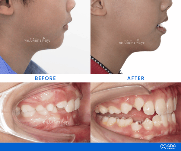 Kid braces overjet buck teeth review