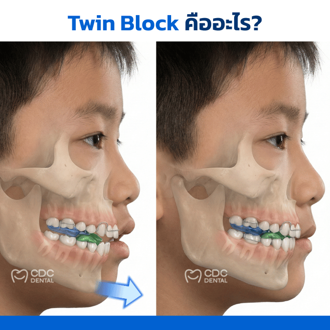 Twin block braces for buck teeth