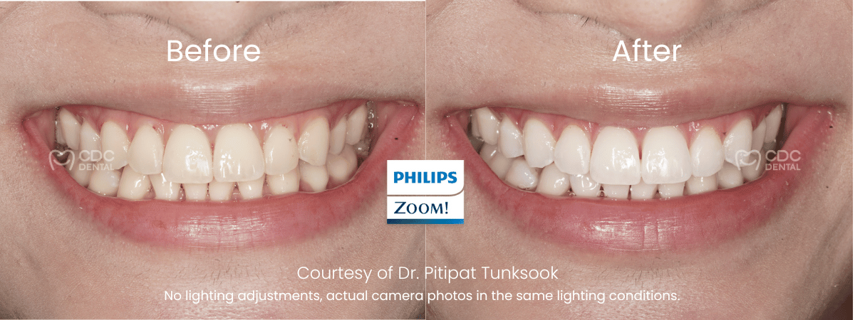 zoom teeth whitening before after