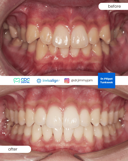จัดฟันใส invisalign teen รีวิว