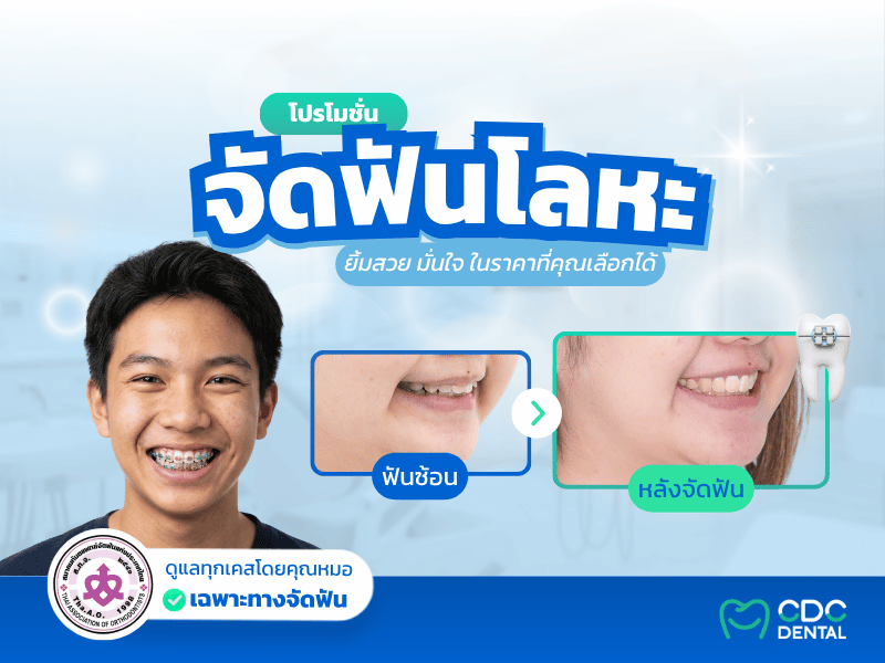 โปรโมชั่นจัดฟันโลหะ CDC Dental สะพานควาย และบางกะปิ ปี 2569
