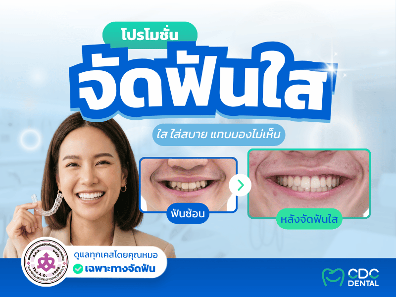 จัดฟันใส โดยหมอเฉพาะทางจัดฟัน