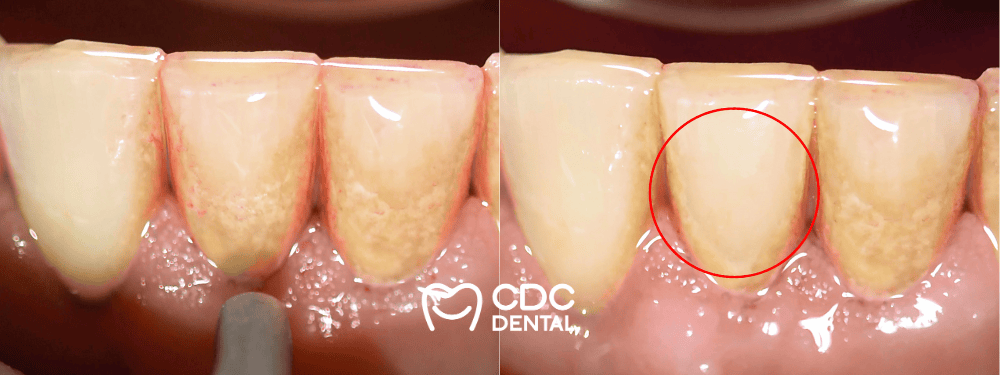 ทำความสะอาดหินปูนนิ่ม