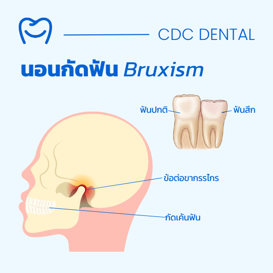 นอนกัดฟัน ฟันสึก
