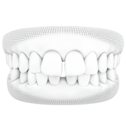 จัดฟันใสรอบสอง