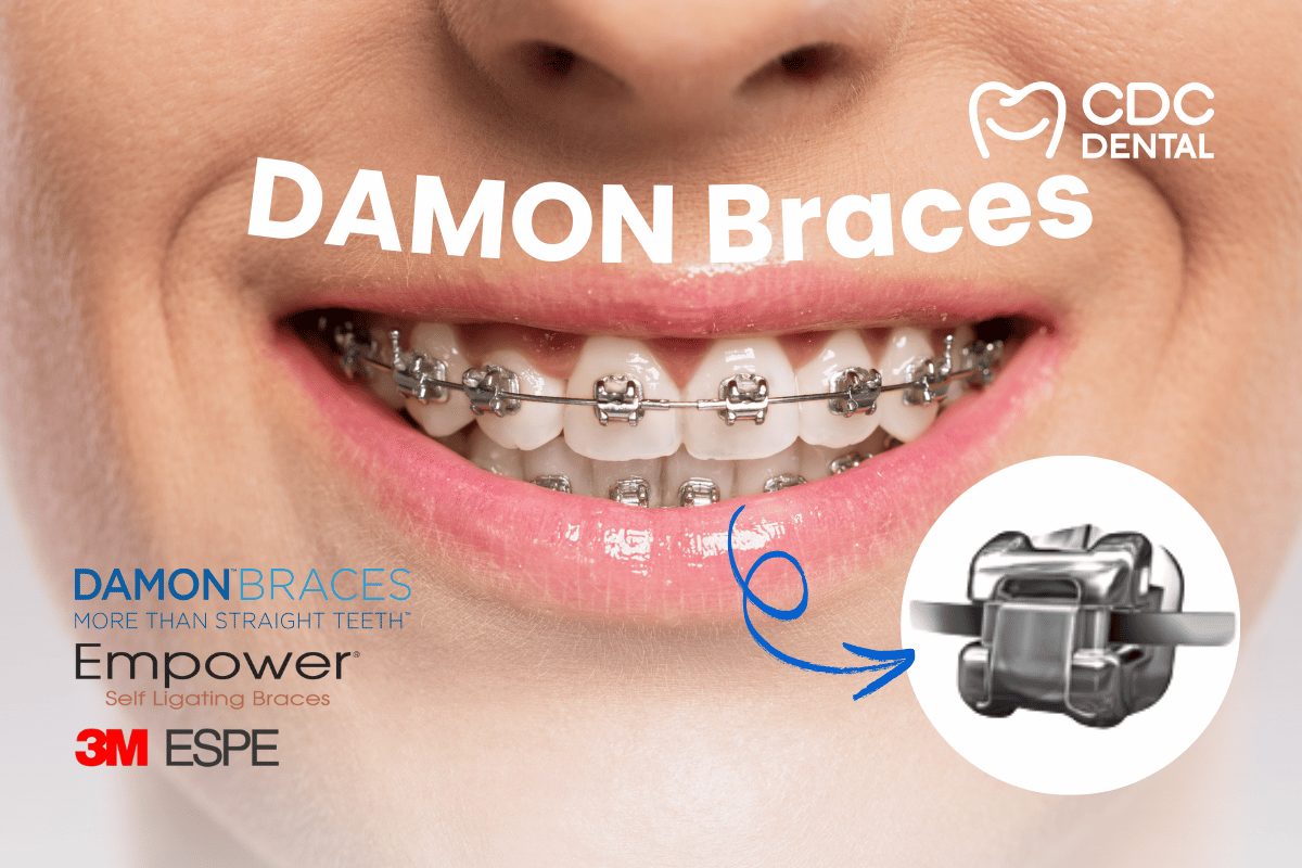 เครื่องมือจัดฟันดามอนแท้จาก USA