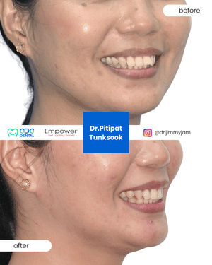 จัดฟันดามอน รีวิวรอยยิ้ม