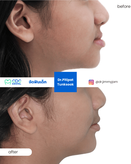 จัดฟัน facemask รีวิว