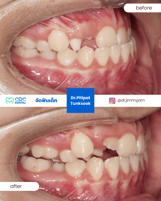 จัดฟันในเด็ก ฟันหน้าล่างคร่อมฟันหน้าบน