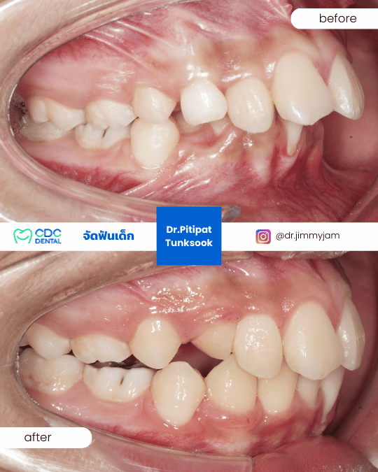 รีวิวจัดฟันเด็ก ฟันยื่น