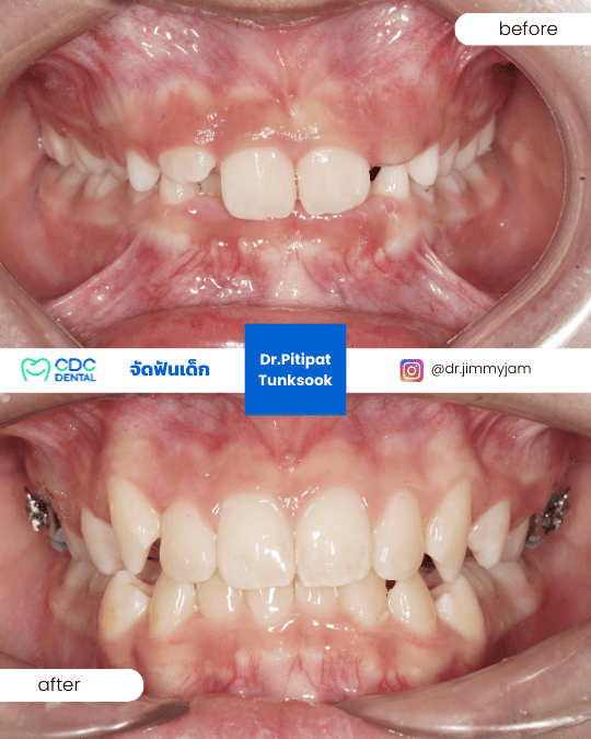 จัดฟันเด็ก ขยายเพดาน