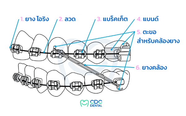 ส่วนประกอบเครื่องมือจัดฟันโลหะ แบร็คเก็ตและลวดจัดฟัน