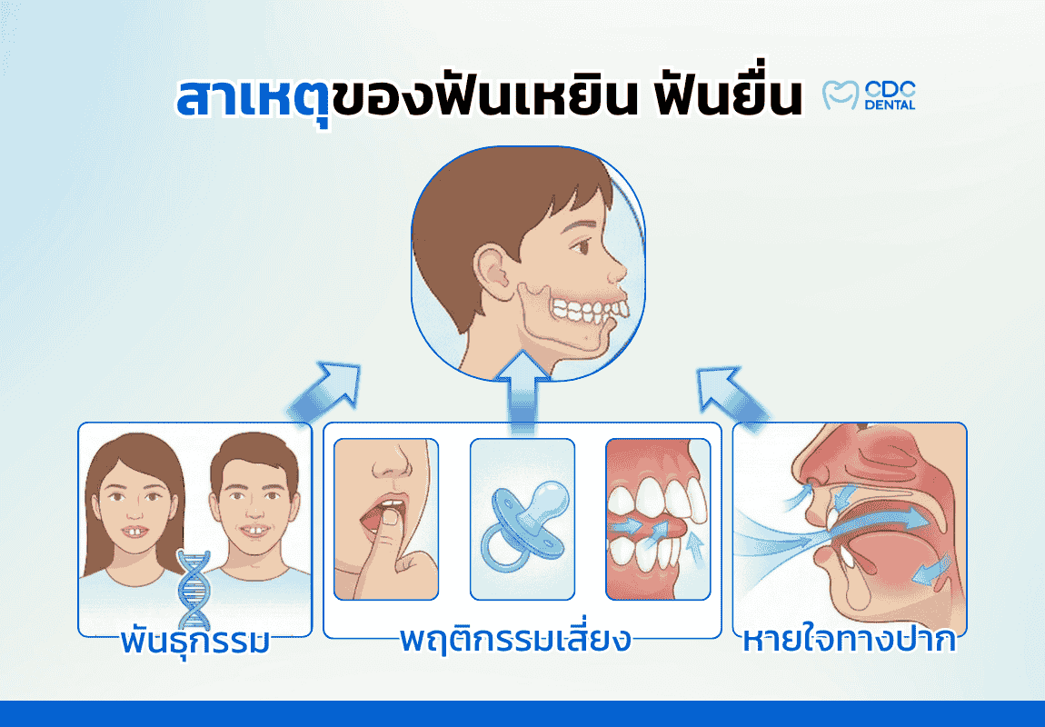 ลูกฟันเหยิน เกิดจาก