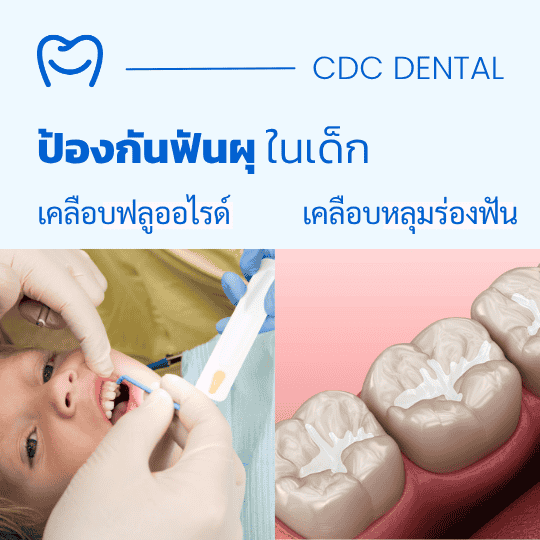 เคลือบฟลูออไรด์