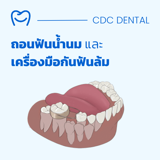 ถอนฟันน้ำนม