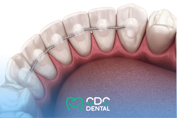 รีเทนเนอร์ติดแน่น