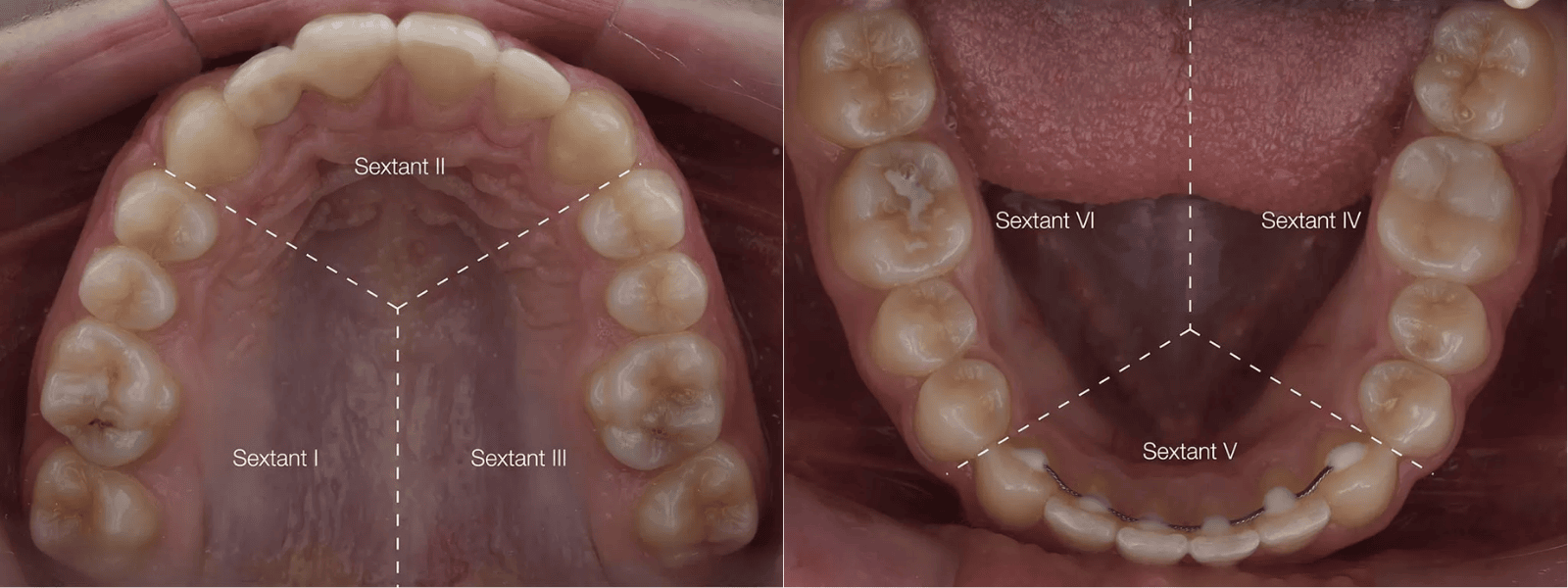 dental sextant
