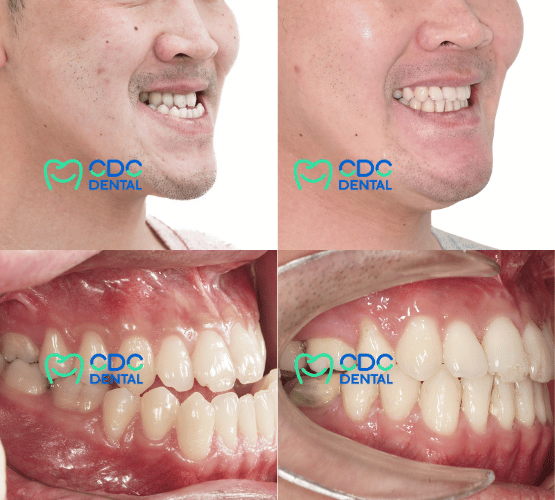 เคสตัวอย่างคางยื่น ฟันล่างครอบฟันบน ก่อนและหลังผ่าตัด 2 ขากรรไกรและคาง CDC Dental