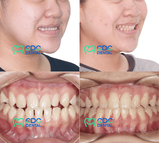 เคสตัวอย่างคางเบี้ยว คางยื่น ก่อนและหลังผ่าตัด 2 ขากรรไกร CDC Dental